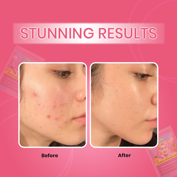 Turmeric & Kojic Acid Pads – Skin Brightening & Acne Treatment