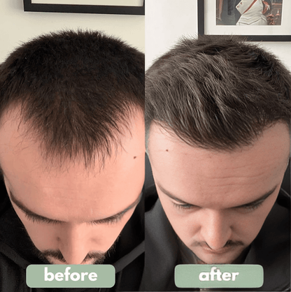 RapidRoot™ Hair Growth Roll-On Serum (25 mL)
